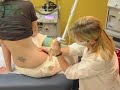 watch-as-cosmetic-lasers-reduce-eliminate-my-stretch-marks-.html