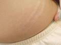 Watch as Cosmetic Lasers Reduce & Eliminate My Stretch Marks
