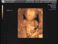 Twins 4d Ultrasound 14 weeks 6 days old.