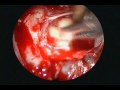 TSHoma - Pituitary Adenoma TSHoma - Pituitary Adenoma