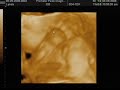 3D Ultrasound 5-9-08 25 weeks