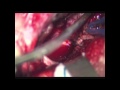 Interhemispheric transcallosal approach for resection of intraventricular central neurocytoma