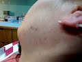 Ear Surface Piercing by HeinZ