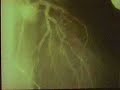 Angiography