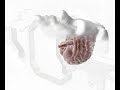 CJW GAMMA KNIFE