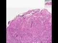 Histopathology Skin-- Squamous cell carcinoma