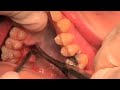 Titamed: Placement Smile 3 Distractor