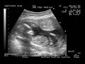 15 SEMANAS.BEBE EN  UTERO. VISTO POR  ECOGRAFIA