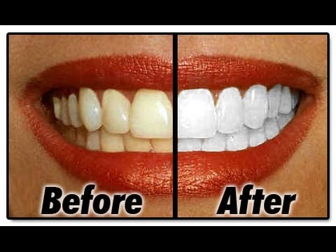 how to whiten old teeth