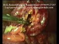 laparoscopy-appendicectomy-video-2-keyhole-lap-appendix.html