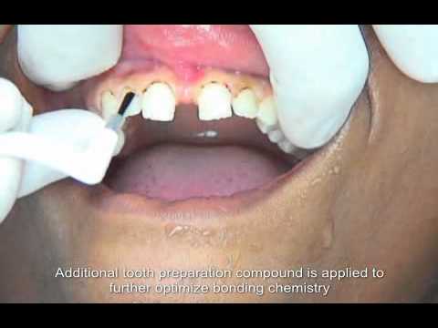 Resin Bonding - SanDentistry