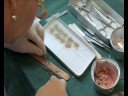 Greffe de cheveux - Hair transplant - Paris Greffe de cheveux - Hair transplant - Paris