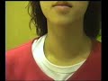 Goiter minimization under Thyroid Throu - Case3 after
