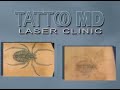 Tattoo MD Laser Clinic - Dr. Alex Kaplan