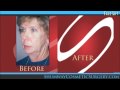 Facelift in La Jolla, San Diego, CA by Dr. Robert Shumway