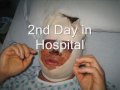 My Facial Feminization Surgery