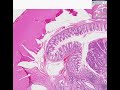 Histopathology Colon --Adenocarcinoma