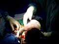 parto por cesaria con cordon umbilical enredado. parto por cesaria con cordon umbilical enredado.