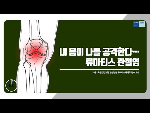 [국민건강보험 일산병원 60초 건강툰]내 몸이 나를 공격한다…류마티스 관절염