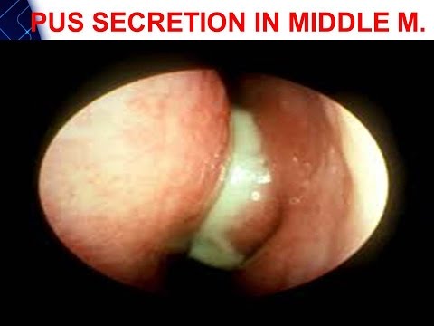 how to drain maxillary sinus