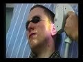 Lasers and acne: RTE TV interview