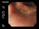 Insertion of EGD Insertion of EGD