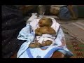 bambino malato di ittiosi, no alieno