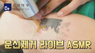 문신제거