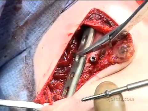 clavicular - We are working on more HD Medical Videos. Please consider donations, Paypal @ adamcox2222@gmail.com.