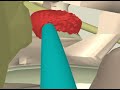 Virtual Tour of Endoscopic Surgery