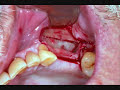 Cirurgia de Levantamento de Seio Maxilar Cirurgia de Levantamento de Seio Maxilar