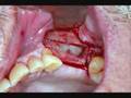 Cirurgia-de-Levantam