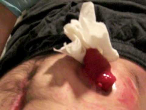 how to care for ileostomy care-stoma