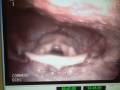 Oboist with vocal cord issues vs the Scope