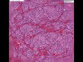 Histopathology Adrenal--Neuroblastoma