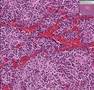 Histopathology Adrenal--Neuroblastoma