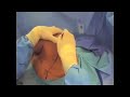 Dr. James Wittig: Radical Partial Scapula Resection [Part 1]