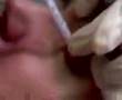 I got an injection...IN MY EYEBALL