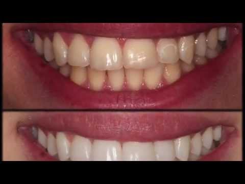 how to whiten bonding