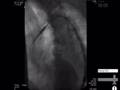 Live Webcast: Thoracic Aortic Aneurysm Repair w/ Cook Zenith 