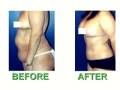 ABDOMINOPLASTY - Dr. Larry Weinstein, M.D. F.A.C.S.