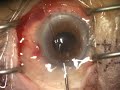 IFIS, cataract surgery 白内障手術(3)