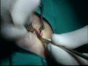 Offene Operation des Karpaltunnelsyndroms