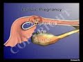 Ectopic pregnancy signs&symptoms from Pregnancy Special Ectopic pregnancy signs&symptoms