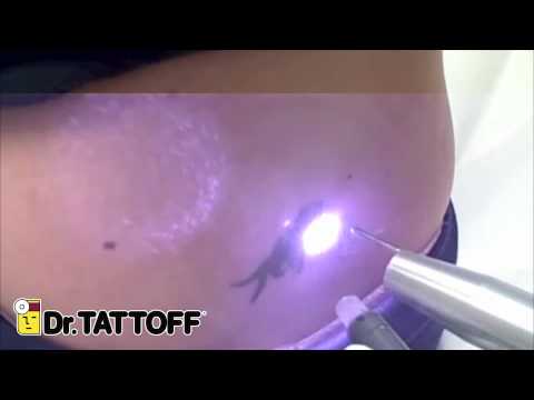 Tattoo Removal - Tribal Sunflower on Lower Back