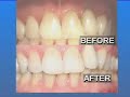 Cheap, Fast Teeth Whitening Cheap, Fast Teeth Whitening