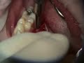 Root Coverage Graft, Recession from Tongue Piercing