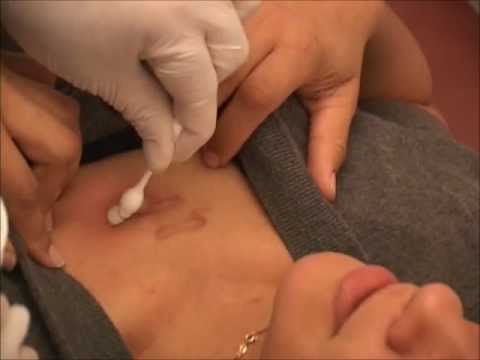 how to treat keloids