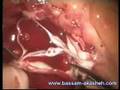 Aortic valve preservation David I Procedure
