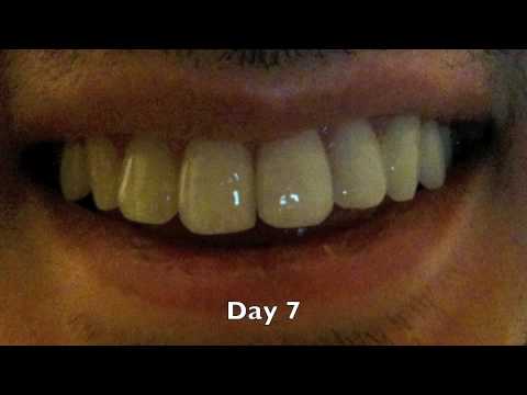 how to whiten permanently stained teeth